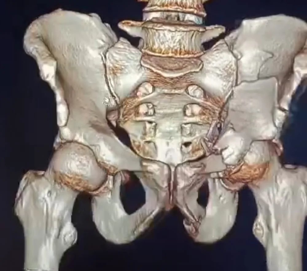 Pelvic fracture reconstruction by Dr Chetan M Dojode