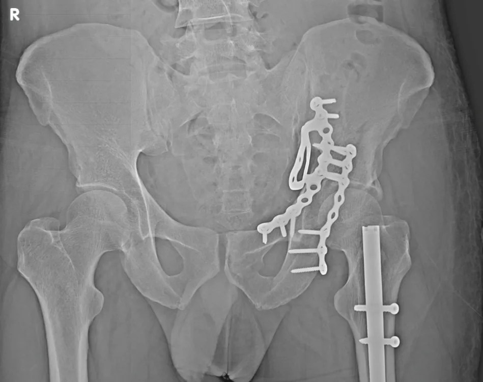 Pelvic and acetabular fracture fixation radiograph