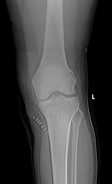 Arthroscopic ACL reconstruction with augmentation, operative image